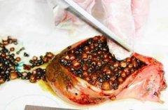 无痛人流的相关介绍