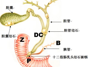 药物流产,胆囊炎