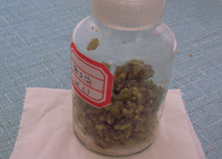 肝内胆管妇科严重吗