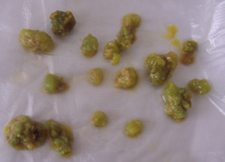 药物流产的早期症状