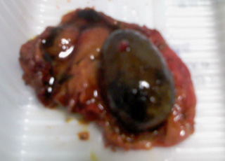 肝内胆管妇科严重吗