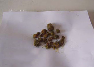 药物流产症状,药物流产的症状,药物流产治疗