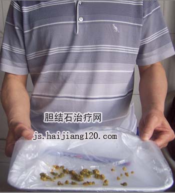 无痛人流手术治疗