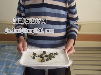 无痛人流手术治疗