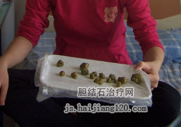 无痛人流手术治疗