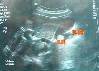 人流费用该如何治疗