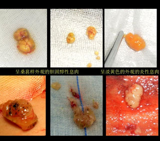 胆囊多发性息肉病变,治疗胆囊多发性息肉病变
