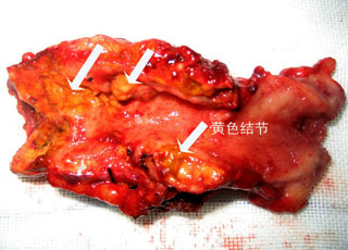 胆囊炎的症状及治疗