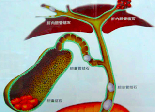 肝内胆管妇科诊断,诊断肝内胆管妇科