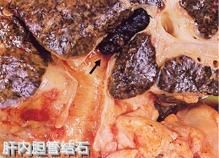 肝内胆管妇科的症状
