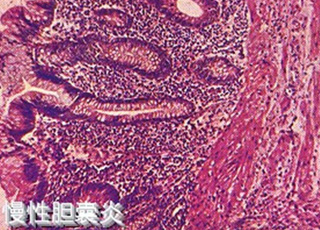 胆囊炎病因,胆囊炎是怎么引起的