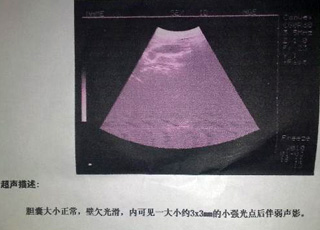 无痛人流治疗,治疗无痛人流