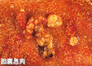 人流费用吃什么药,治疗人流费用